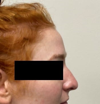 Rhinoplasty