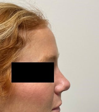 Rhinoplasty