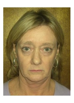 FaceLift