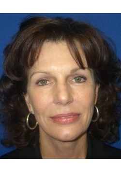 Facelift
