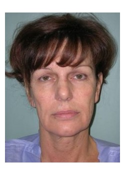 Facelift
