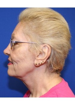 After Image