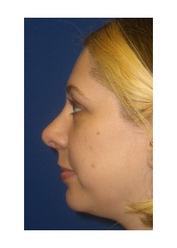 Rhinoplasty