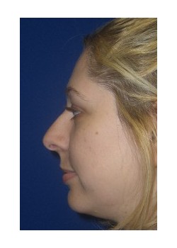 Rhinoplasty