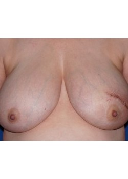 DIEP Flap
