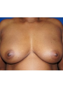 DIEP Flap