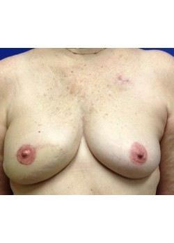 DIEP Flap