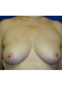 DIEP Flap