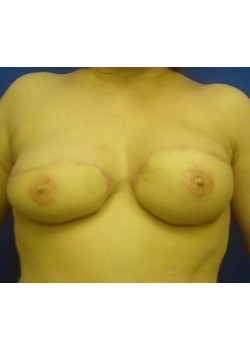 DIEP Flap