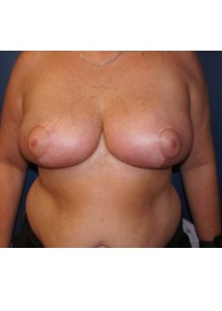 Breast Reduction