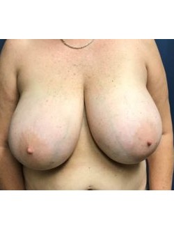 Breast Reduction