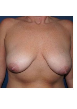 Breast Augmentation with Lift