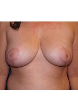 Breast Reduction