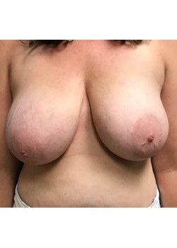 Breast Reduction