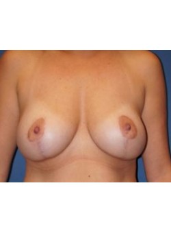 Breast Augmentation with Lift