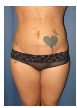 Circumferential Liposuction