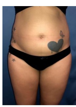 Circumferential Liposuction