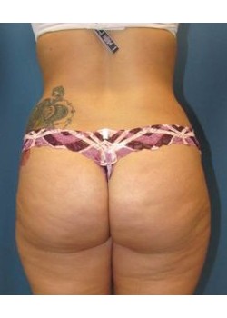 Brazilian Butt Lift