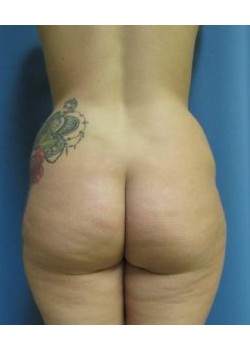 Brazilian Butt Lift