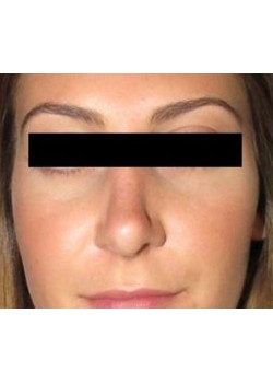 Rhinoplasty