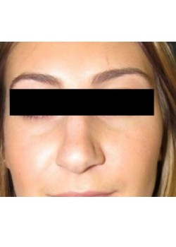Rhinoplasty