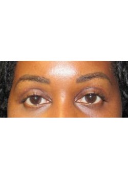Upper Blepharoplasty
