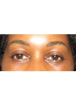 Upper Blepharoplasty