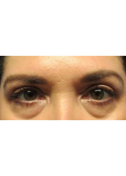 Blepharoplasty