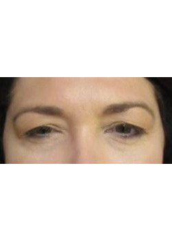 Blepharoplasty