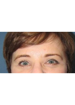 Upper and Lower Blepharoplasty