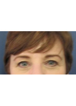 Upper and Lower Blepharoplasty