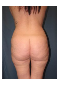 Brazilian Butt Lift