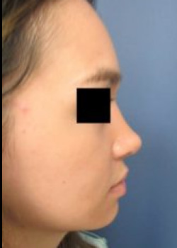 Rhinoplasty