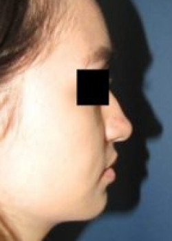 Rhinoplasty