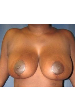 Breast Reduction