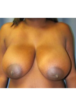 Breast Reduction