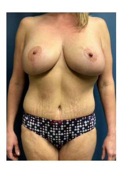 Mommy Makeover
