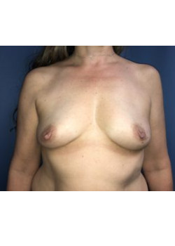 Breast Augmentation
