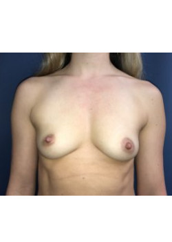 Breast Augmentation