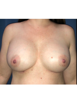 Breast Augmentation