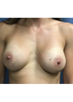 Breast Augmentation