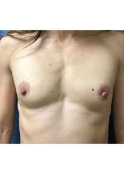 Breast Augmentation