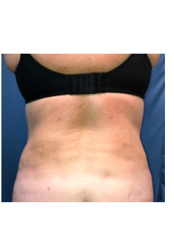 Liposuction of Flanks