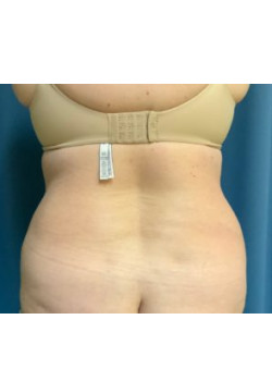 Liposuction of Flanks