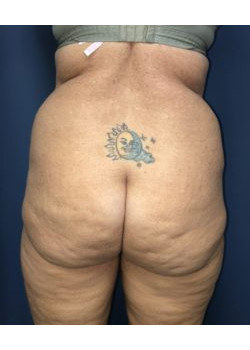 Brazilian Butt Lift