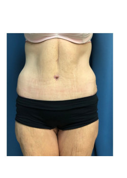 Panniculectomy with Abdominoplasty