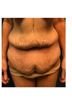 Panniculectomy with Abdominoplasty