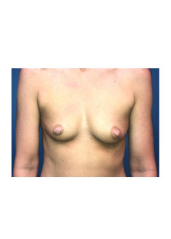 Breast Augmentation