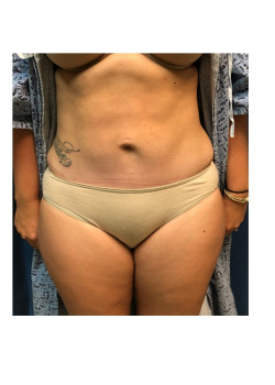 Mini Tummy Tuck with Liposuction