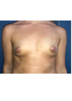 Breast Augmentation